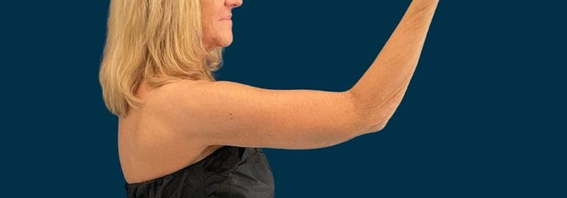 Brachioplasty (Arm Lifts) Before & After Gallery - Patient 346285 - Image 10