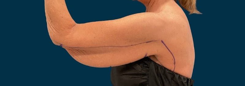 Brachioplasty (Arm Lifts) Before & After Gallery - Patient 346285 - Image 11