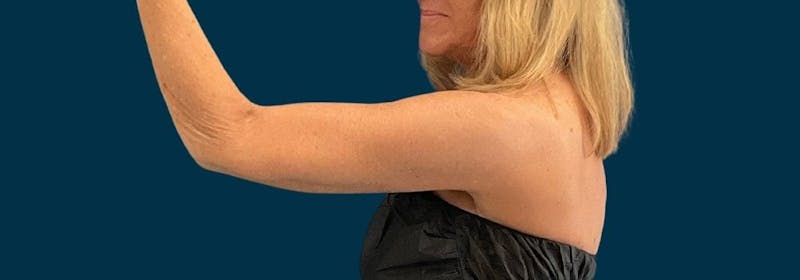 Brachioplasty (Arm Lifts) Before & After Gallery - Patient 346285 - Image 12