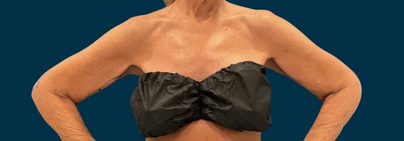 Brachioplasty (Arm Lifts) Before & After Gallery - Patient 346285 - Image 13