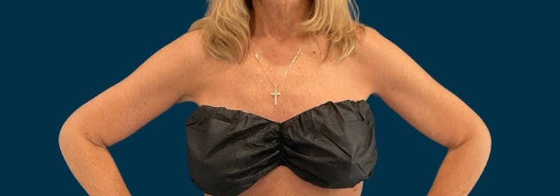 Brachioplasty (Arm Lifts) Before & After Gallery - Patient 346285 - Image 14