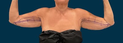 Brachioplasty (Arm Lifts) Before & After Gallery - Patient 139166 - Image 1