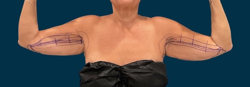 Brachioplasty (Arm Lifts) Before & After Gallery - Patient 139166 - Image 1