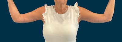 Brachioplasty (Arm Lifts) Before & After Gallery - Patient 139166 - Image 2