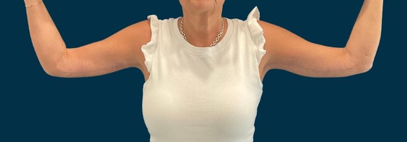 Brachioplasty (Arm Lifts) Before & After Gallery - Patient 139166 - Image 2