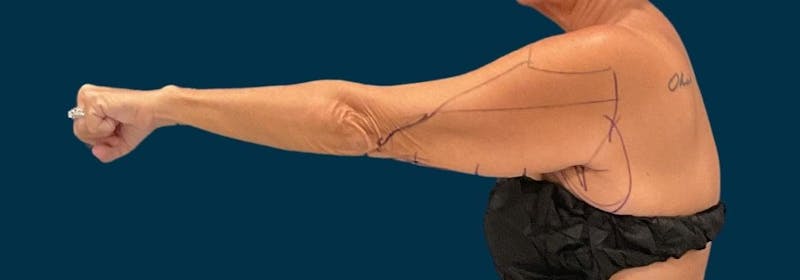 Brachioplasty (Arm Lifts) Before & After Gallery - Patient 139166 - Image 3