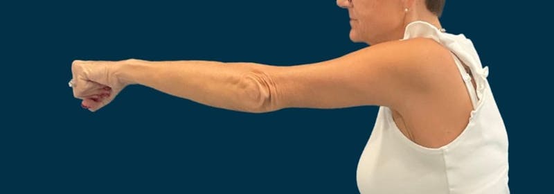 Brachioplasty (Arm Lifts) Before & After Gallery - Patient 139166 - Image 4