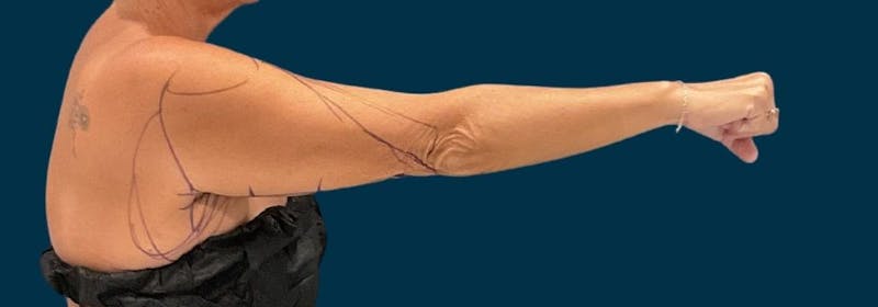 Brachioplasty (Arm Lifts) Before & After Gallery - Patient 139166 - Image 5