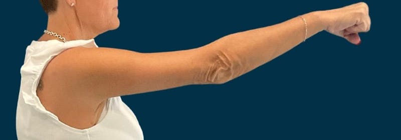 Brachioplasty (Arm Lifts) Before & After Gallery - Patient 139166 - Image 6