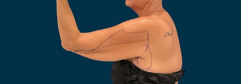 Brachioplasty (Arm Lifts) Before & After Gallery - Patient 139166 - Image 7
