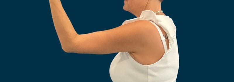Brachioplasty (Arm Lifts) Before & After Gallery - Patient 139166 - Image 8