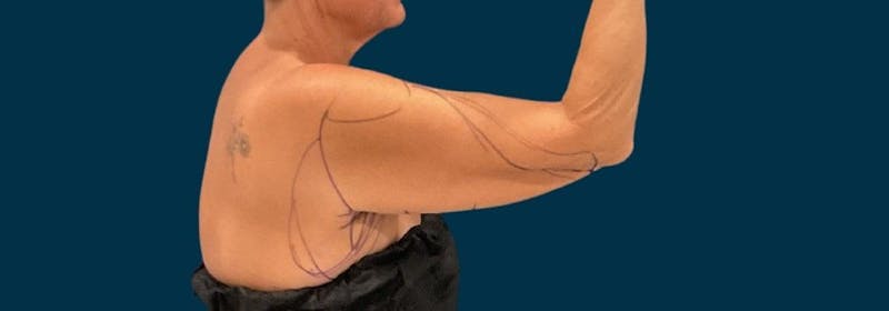 Brachioplasty (Arm Lifts) Before & After Gallery - Patient 139166 - Image 9