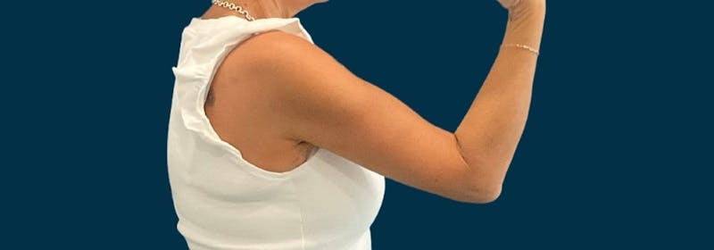 Brachioplasty (Arm Lifts) Before & After Gallery - Patient 139166 - Image 10