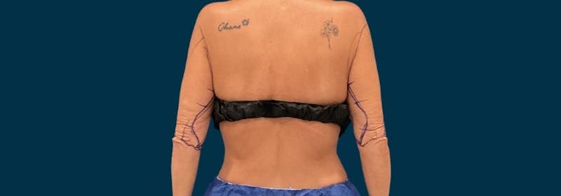Brachioplasty (Arm Lifts) Before & After Gallery - Patient 139166 - Image 11