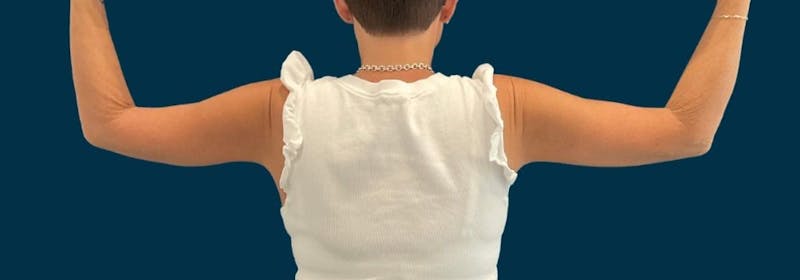 Brachioplasty (Arm Lifts) Before & After Gallery - Patient 139166 - Image 12