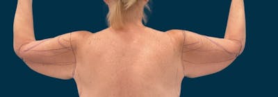 Brachioplasty (Arm Lifts) Before & After Gallery - Patient 156907 - Image 1