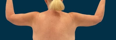 Brachioplasty (Arm Lifts) Before & After Gallery - Patient 156907 - Image 2