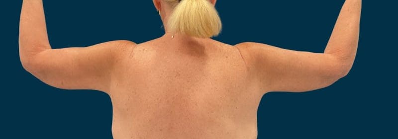 Brachioplasty (Arm Lifts) Before & After Gallery - Patient 156907 - Image 2
