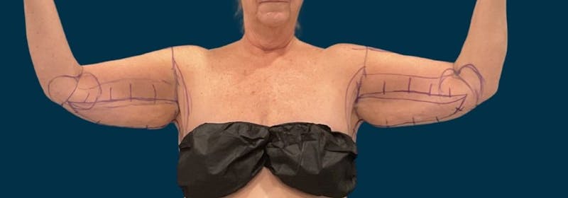 Brachioplasty (Arm Lifts) Before & After Gallery - Patient 156907 - Image 3