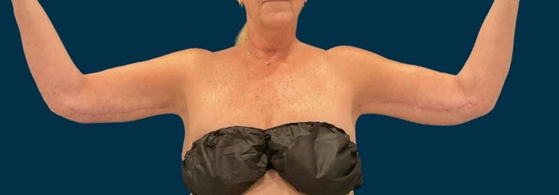 Brachioplasty (Arm Lifts) Before & After Gallery - Patient 156907 - Image 4