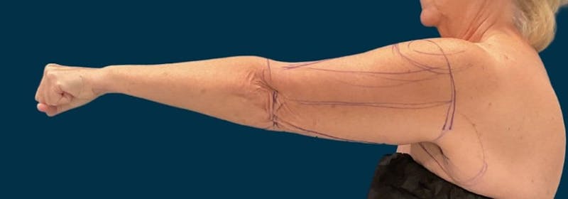 Brachioplasty (Arm Lifts) Before & After Gallery - Patient 156907 - Image 5
