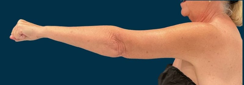 Brachioplasty (Arm Lifts) Before & After Gallery - Patient 156907 - Image 6