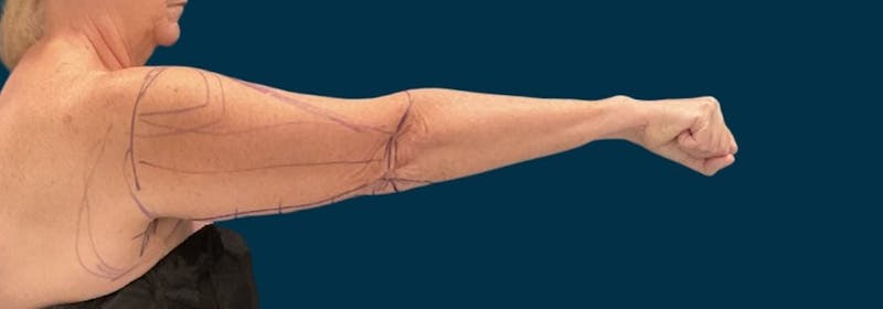 Brachioplasty (Arm Lifts) Before & After Gallery - Patient 156907 - Image 7