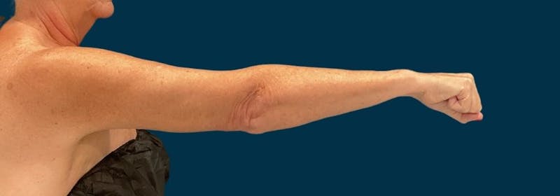 Brachioplasty (Arm Lifts) Before & After Gallery - Patient 156907 - Image 8