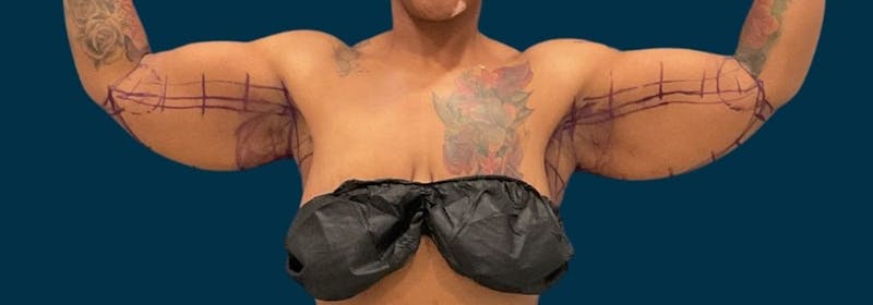 Brachioplasty (Arm Lifts) Before & After Gallery - Patient 321811 - Image 1