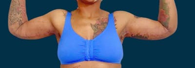 Brachioplasty (Arm Lifts) Before & After Gallery - Patient 321811 - Image 2