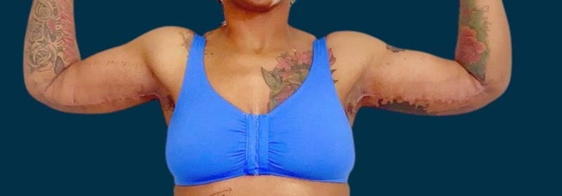 Brachioplasty (Arm Lifts) Before & After Gallery - Patient 321811 - Image 2