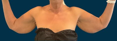 Brachioplasty (Arm Lifts) Before & After Gallery - Patient 110254 - Image 1