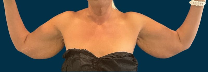 Brachioplasty (Arm Lifts) Before & After Gallery - Patient 110254 - Image 1