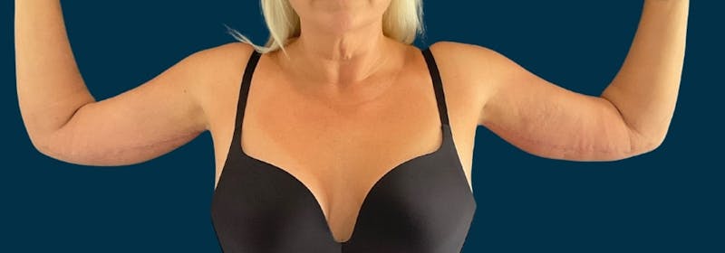 Brachioplasty (Arm Lifts) Before & After Gallery - Patient 110254 - Image 2