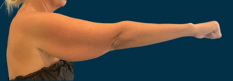 Brachioplasty (Arm Lifts) Before & After Gallery - Patient 110254 - Image 3