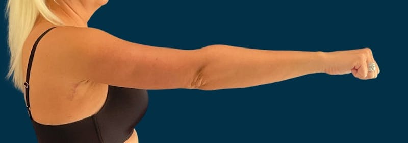 Brachioplasty (Arm Lifts) Before & After Gallery - Patient 110254 - Image 4