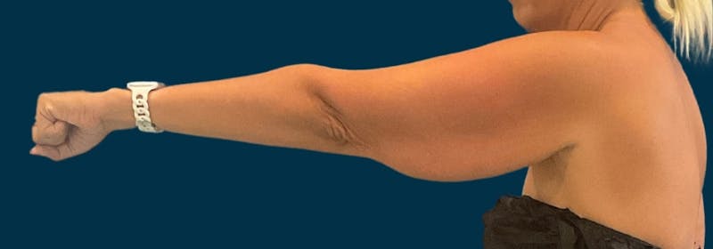 Brachioplasty (Arm Lifts) Before & After Gallery - Patient 110254 - Image 5