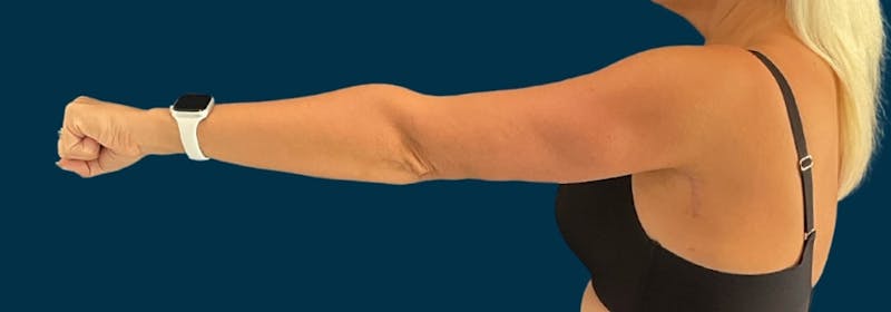 Brachioplasty (Arm Lifts) Before & After Gallery - Patient 110254 - Image 6