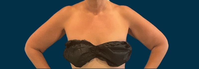 Brachioplasty (Arm Lifts) Before & After Gallery - Patient 110254 - Image 7
