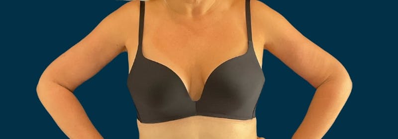 Brachioplasty (Arm Lifts) Before & After Gallery - Patient 110254 - Image 8