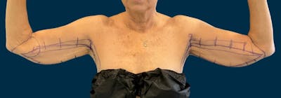 Brachioplasty (Arm Lifts) Before & After Gallery - Patient 197680 - Image 1