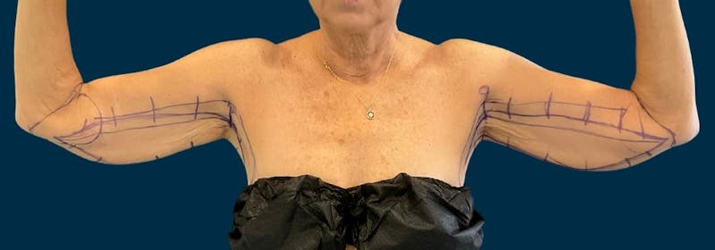 Brachioplasty (Arm Lifts) Before & After Gallery - Patient 197680 - Image 1