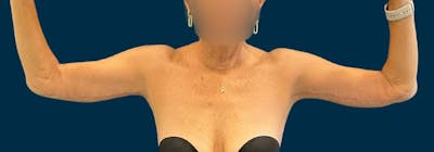 Brachioplasty (Arm Lifts) Before & After Gallery - Patient 197680 - Image 2