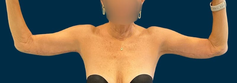 Brachioplasty (Arm Lifts) Before & After Gallery - Patient 197680 - Image 2