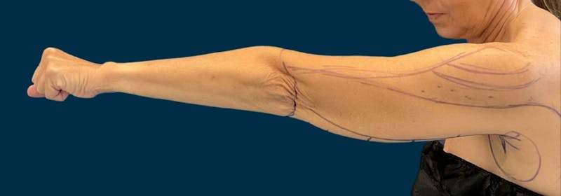 Brachioplasty (Arm Lifts) Before & After Gallery - Patient 197680 - Image 3