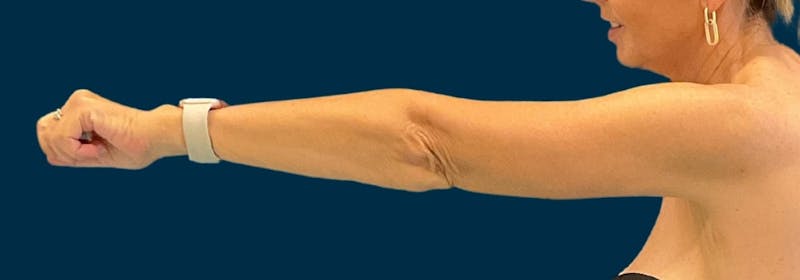 Brachioplasty (Arm Lifts) Before & After Gallery - Patient 197680 - Image 4