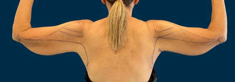 Brachioplasty (Arm Lifts) Before & After Gallery - Patient 197680 - Image 5
