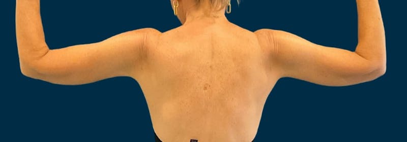 Brachioplasty (Arm Lifts) Before & After Gallery - Patient 197680 - Image 6