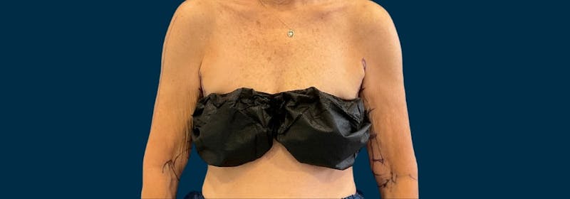 Brachioplasty (Arm Lifts) Before & After Gallery - Patient 197680 - Image 7