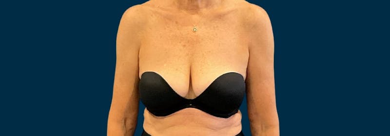 Brachioplasty (Arm Lifts) Before & After Gallery - Patient 197680 - Image 8